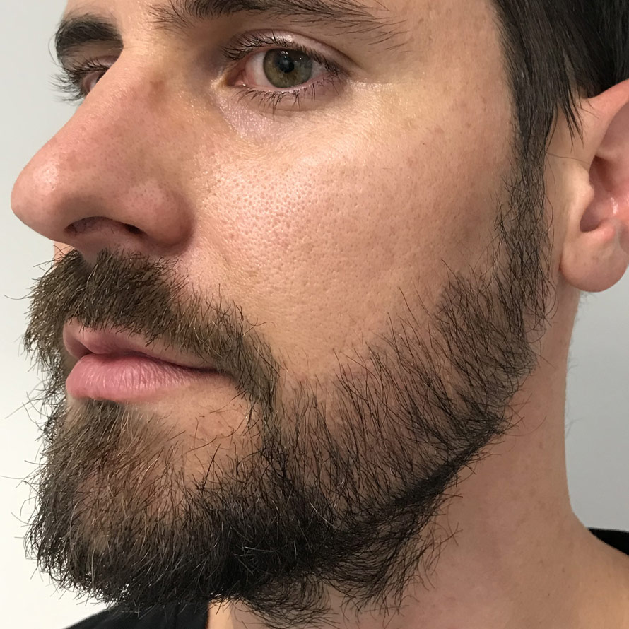 Beard Transplants in Melbourne & Sydney