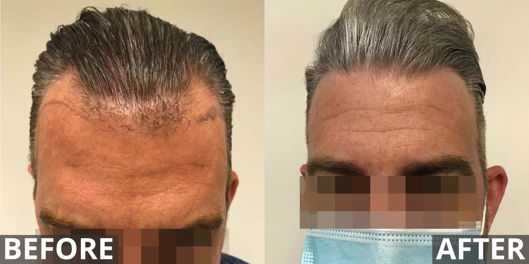 Hair transplant before and after gallery