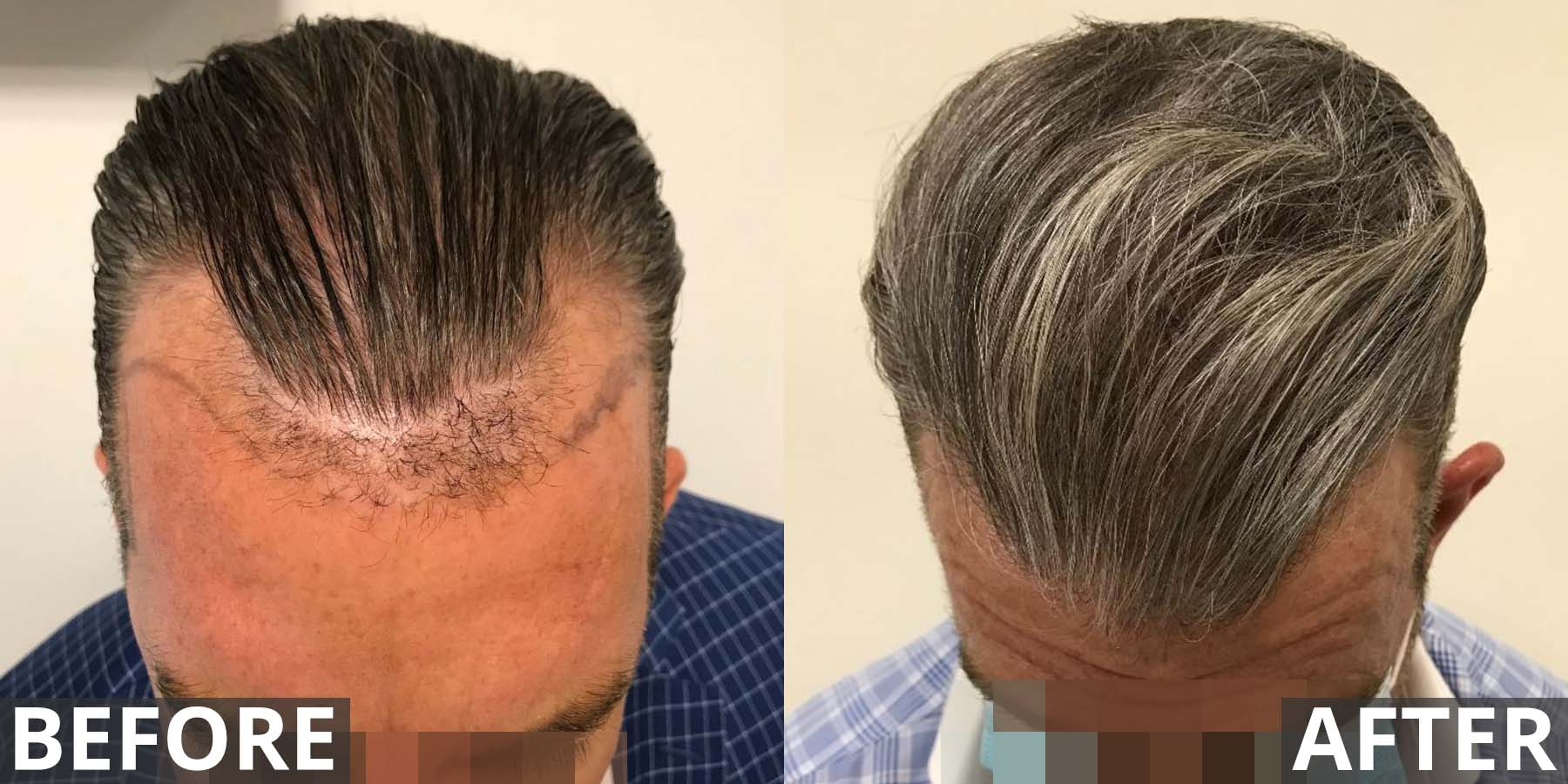 Hair transplant before and after gallery