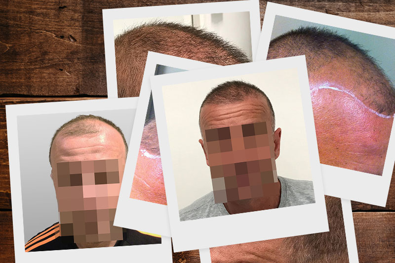 Roger's FUE Hair Transplant Journey - Paras Hair Transplant Roger's FUE Hair Transplant Journey - Paras Hair Transplant