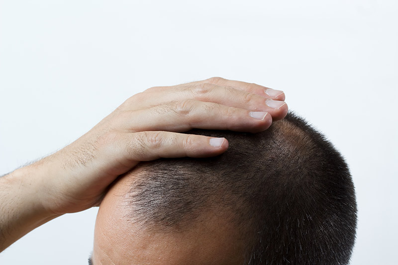 Do FUE Hair Transplants Hurt? - Paras Hair Transplant Clinic