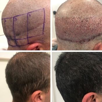 blog hair transplant scars can they be repaired th