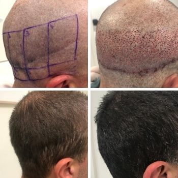 Lamme Bærbar Potentiel The latest articles from Paras Hair Transplant Clinic