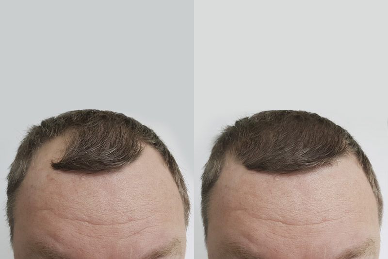 WHAT TO EXPECT AFTER A HAIR TRANSPLANT | MAXIM HAIR RESTORATION