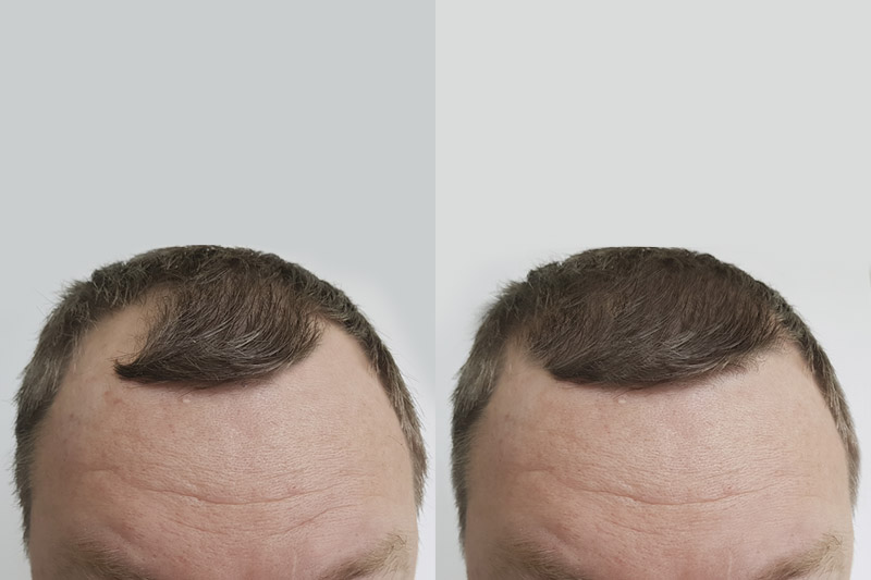 Hair Transplant After 4 Months What To Expect