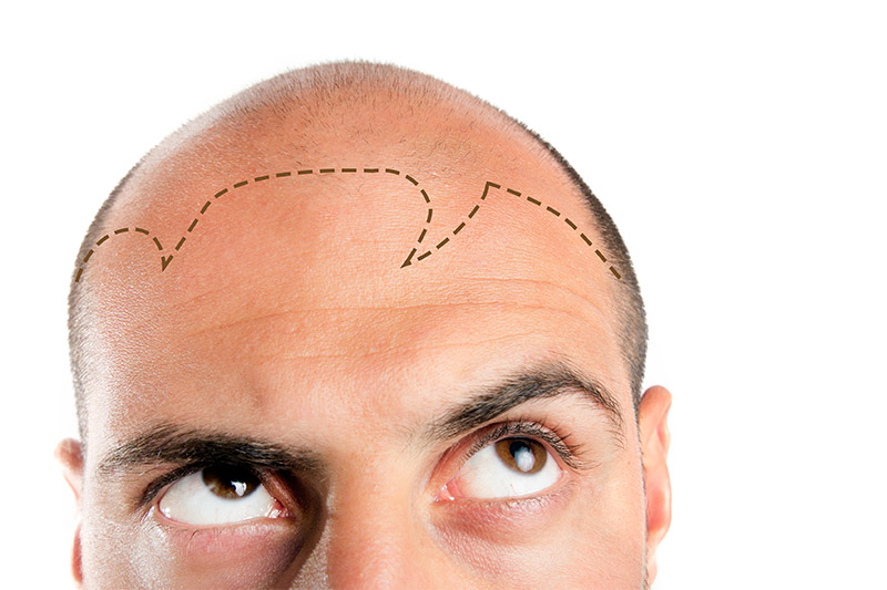 Will an FUE hair transplant look obvious?