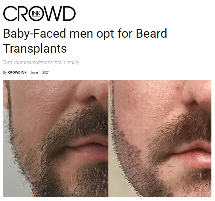 crowd ink baby faced men opt for beard transplants