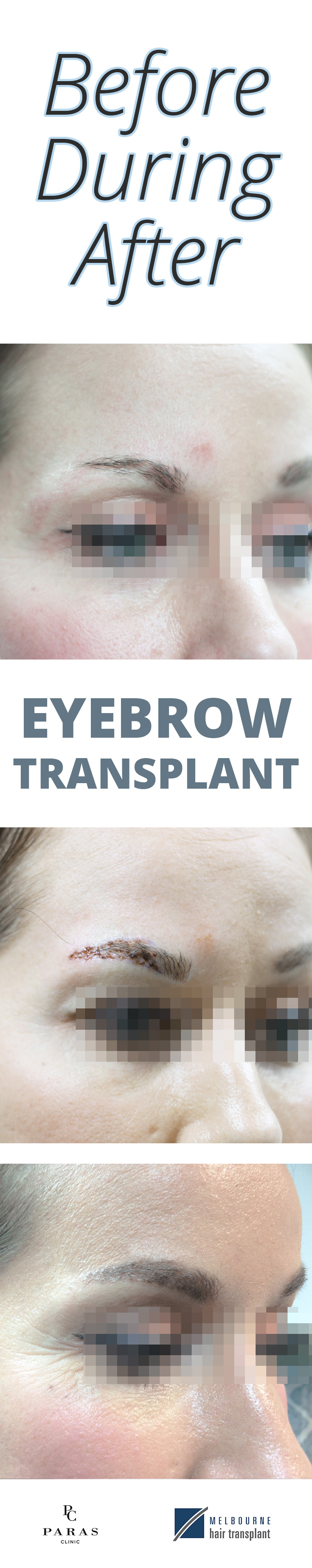 eyebrow transplant pin