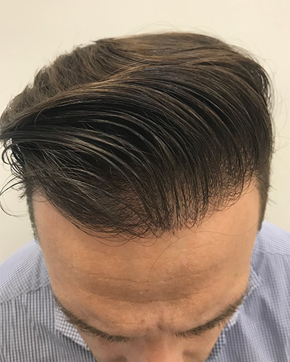 g hair transplant journey10