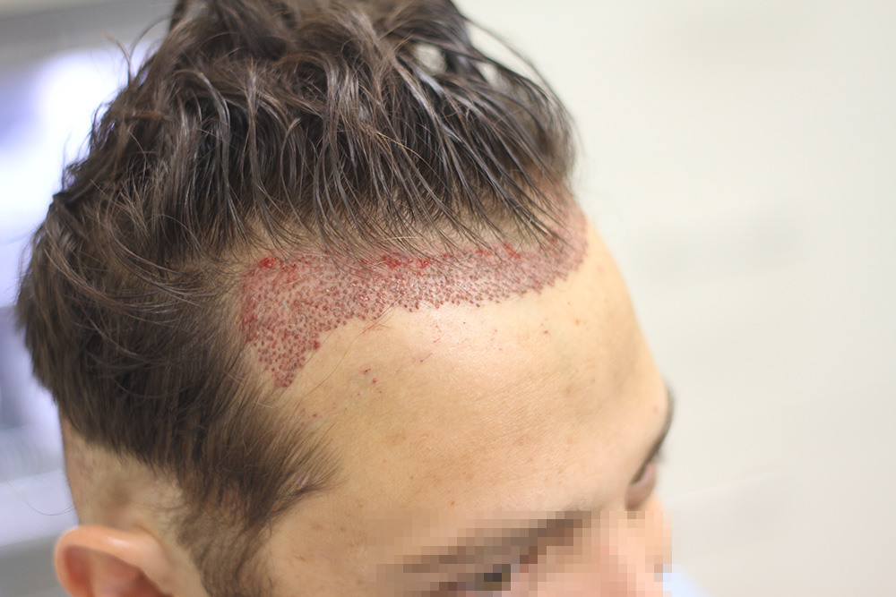 Achieve Great Hair Transplant Results with Shorter Sessions