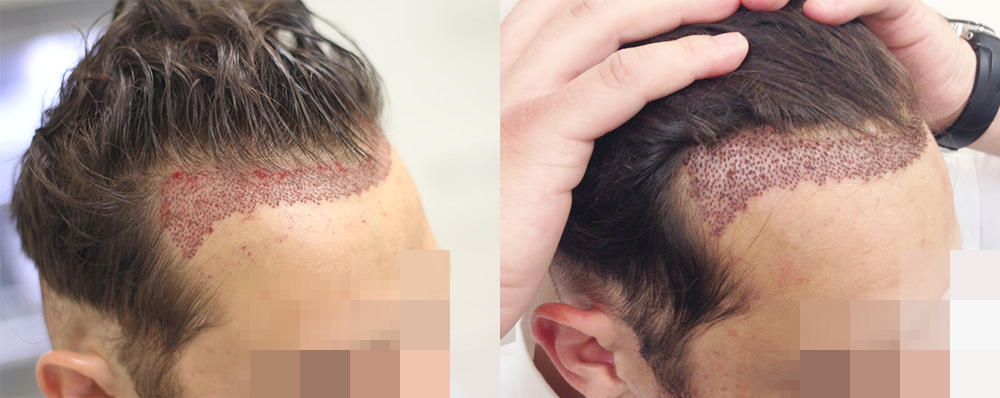 g hair transplant journey7 b